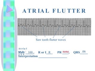 ATRIAL FLUTTER Rate _____,  R or I____  PR ____,  QRS_____ Interpretation __________________ 100 R none .06 Saw tooth flutter waves Atrial rate: 300 