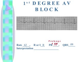 1 st  DEGREE AV BLOCK Rate _____,  R or I___  PR ____,  QRS_____ Interpretation __________________ 62 R . 32 .08 Prolonged PR 