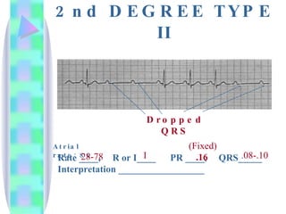 2nd DEGREE TYPE II Rate ____,  R or I____  PR ____,  QRS_____ Interpretation __________________ I (Fixed)  .16 . 08-.10 Dropped QRS Atrial rate: 80 28-78 