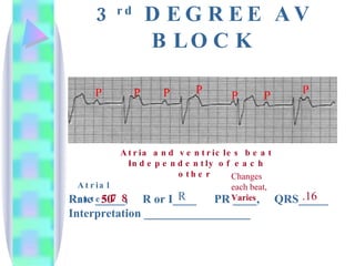 3 rd  DEGREE AV BLOCK Rate _____,  R or I____  PR ____,  QRS_____ Interpretation __________________ 50 R Changes each beat,  Varies .16 Atrial rate:  78 Atria and ventricles beat Independently of each other  P P P P P P P 