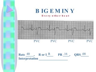 BIGEMINY Rate _____,  R or I____  PR ____,  QRS_____ Interpretation __________________ PVC PVC PVC PVC 40 R .16 .08 Every other beat 