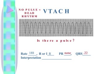 VTACH Rate _____,  R or I____  PR ____,  QRS_____ Interpretation __________________ 188 R none .22 Is there a pulse?   NO PULSE = DEAD RHYTHM 