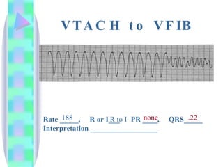 VTACH to VFIB Rate _____,  R or I___  PR ____,  QRS_____ Interpretation __________________ none 188 .22 R to I 