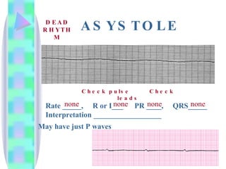ASYSTOLE Rate _____,  R or I___  PR ____,  QRS_____ Interpretation __________________ none none none none Check pulse Check leads DEAD RHYTHM May have just P waves  