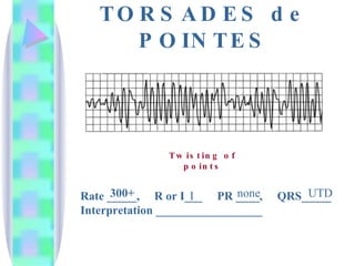 TORSADES de POINTES Rate _____,  R or I___  PR ____,  QRS_____ Interpretation __________________ 300+ I none UTD Twisting of points 