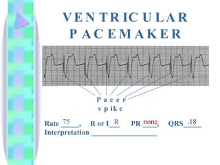 VENTRICULAR PACEMAKER Rate _____,  R or I___  PR ____,  QRS_____ Interpretation __________________ 75 R none .18 Pacer spike 