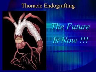Thoracic Endografting
The Future
Is Now !!!
 