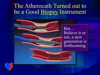 The Atherocath Turned out to
be a Good Biopsy Instrument
But…
Believe it or
not, a new
generation is
forthcoming
 