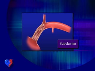 Subclavian
 