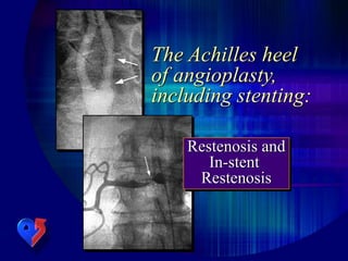 The Achilles heel
of angioplasty,
including stenting:
Restenosis and
In-stent
Restenosis
 