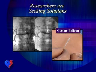 Researchers are
Seeking Solutions
Cutting Balloon
 