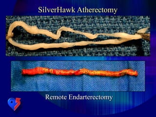 SilverHawk Atherectomy
Remote Endarterectomy
 