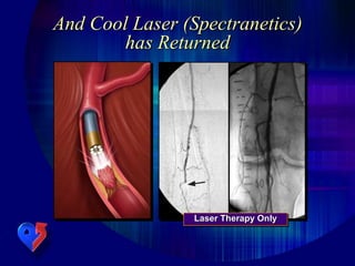 And Cool Laser (Spectranetics)
has Returned
Laser Therapy Only
 