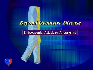 Beyond Occlusive Disease
Endovascular Attack on Aneurysms
 