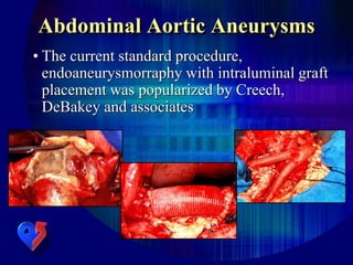 • The current standard procedure,
endoaneurysmorraphy with intraluminal graft
placement was popularized by Creech,
DeBakey and associates
Abdominal Aortic Aneurysms
 