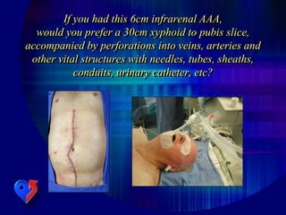 If you had this 6cm infrarenal AAA,
would you prefer a 30cm xyphoid to pubis slice,
accompanied by perforations into veins, arteries and
other vital structures with needles, tubes, sheaths,
conduits, urinary catheter, etc?
 