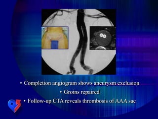 • Completion angiogram shows aneurysm exclusion
• Groins repaired
• Follow-up CTA reveals thrombosis of AAA sac
 