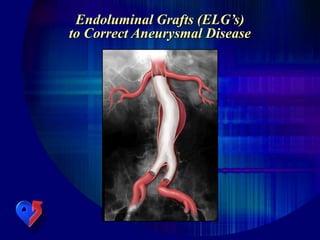Endoluminal Grafts (ELG’s)
to Correct Aneurysmal Disease
 