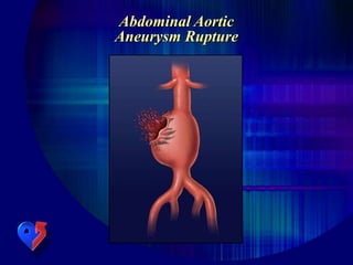 Abdominal Aortic
Aneurysm Rupture
 
