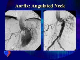Aorfix: Angulated Neck
 