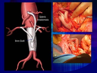 8mm Graft
Splenic
Anastomosis
 
