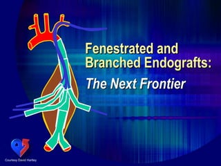 Fenestrated and
Branched Endografts:
Courtesy David Hartley
The Next Frontier
 