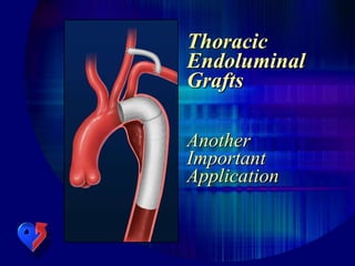 Thoracic
Endoluminal
Grafts
Another
Important
Application
 