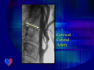 Cervical
Carotid
Artery
 