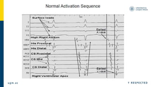 Basic Egm Signals Basic Electrophysiology study and EGM material.pptx