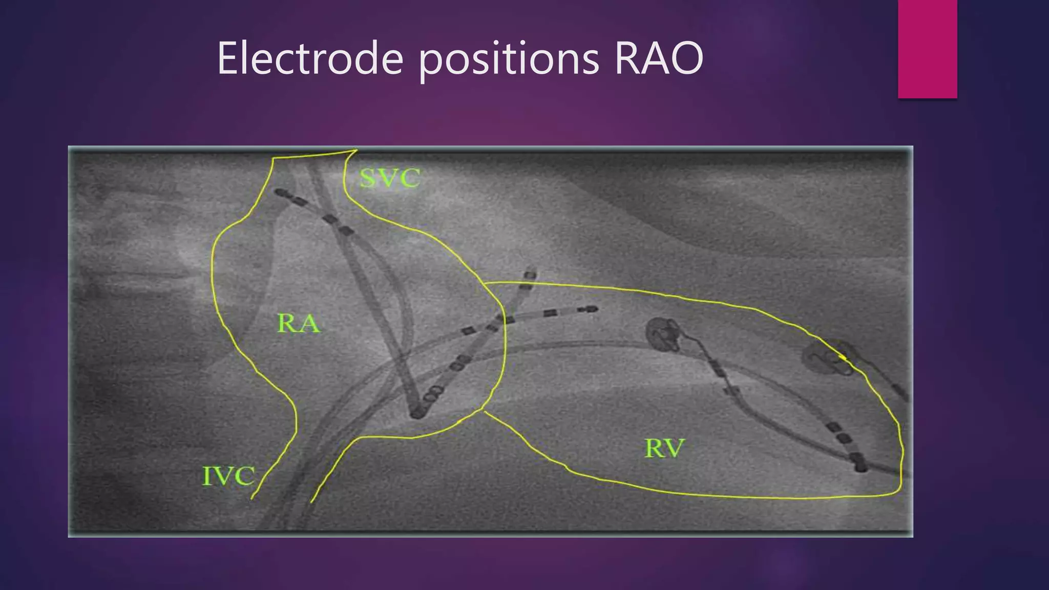 Electrode positions RAO
 