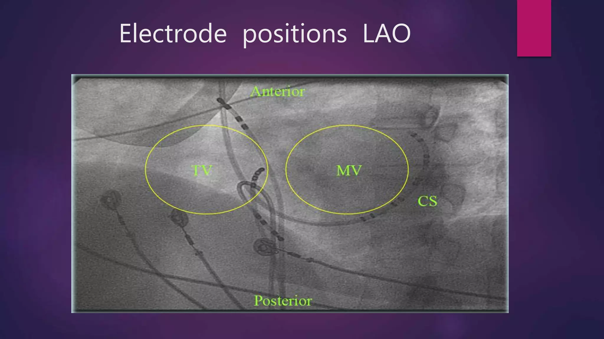 Electrode positions LAO
 