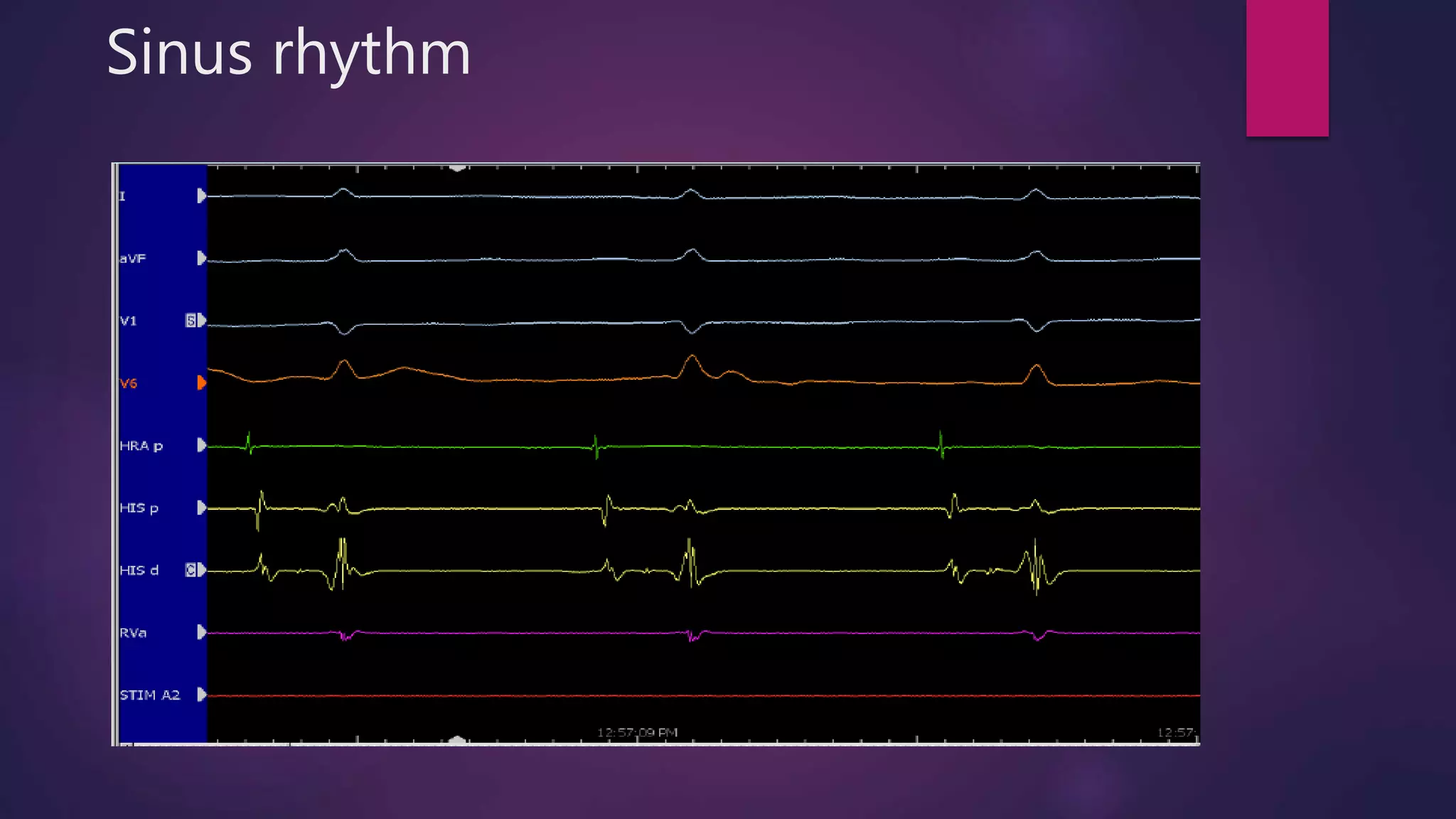Sinus rhythm
 