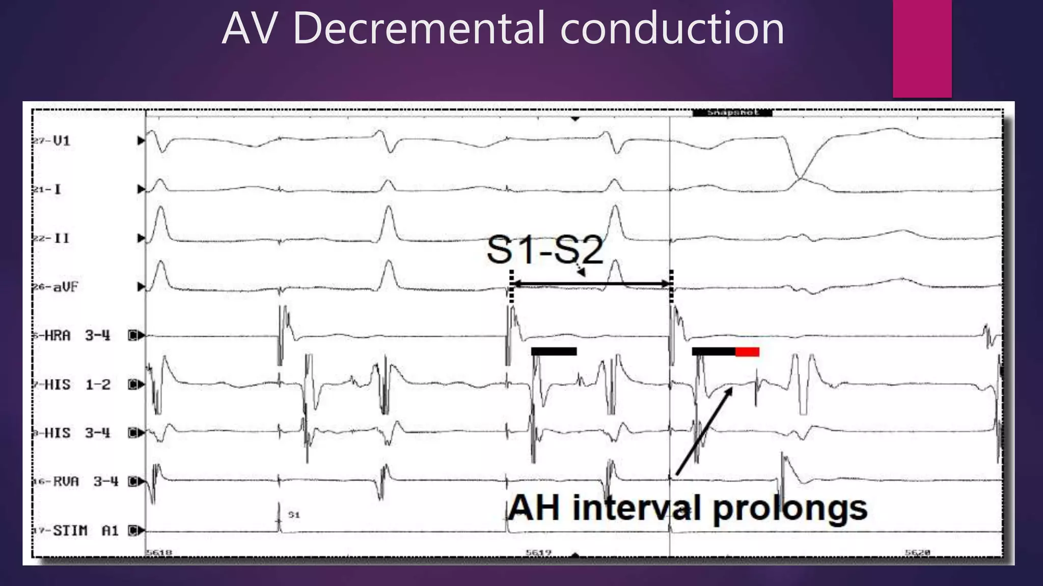 AV Decremental conduction
 