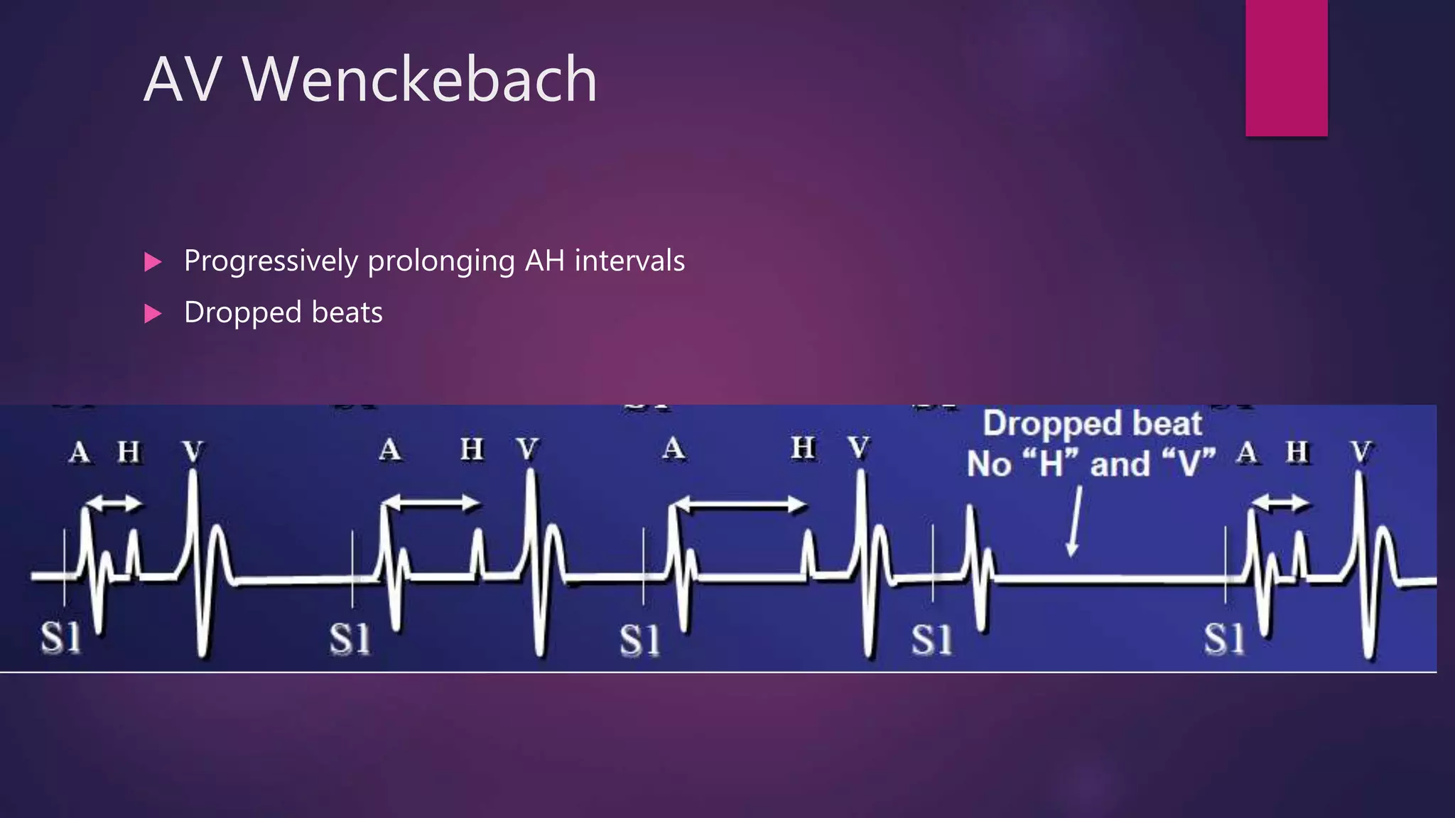AV Wenckebach
 Progressively prolonging AH intervals
 Dropped beats
 