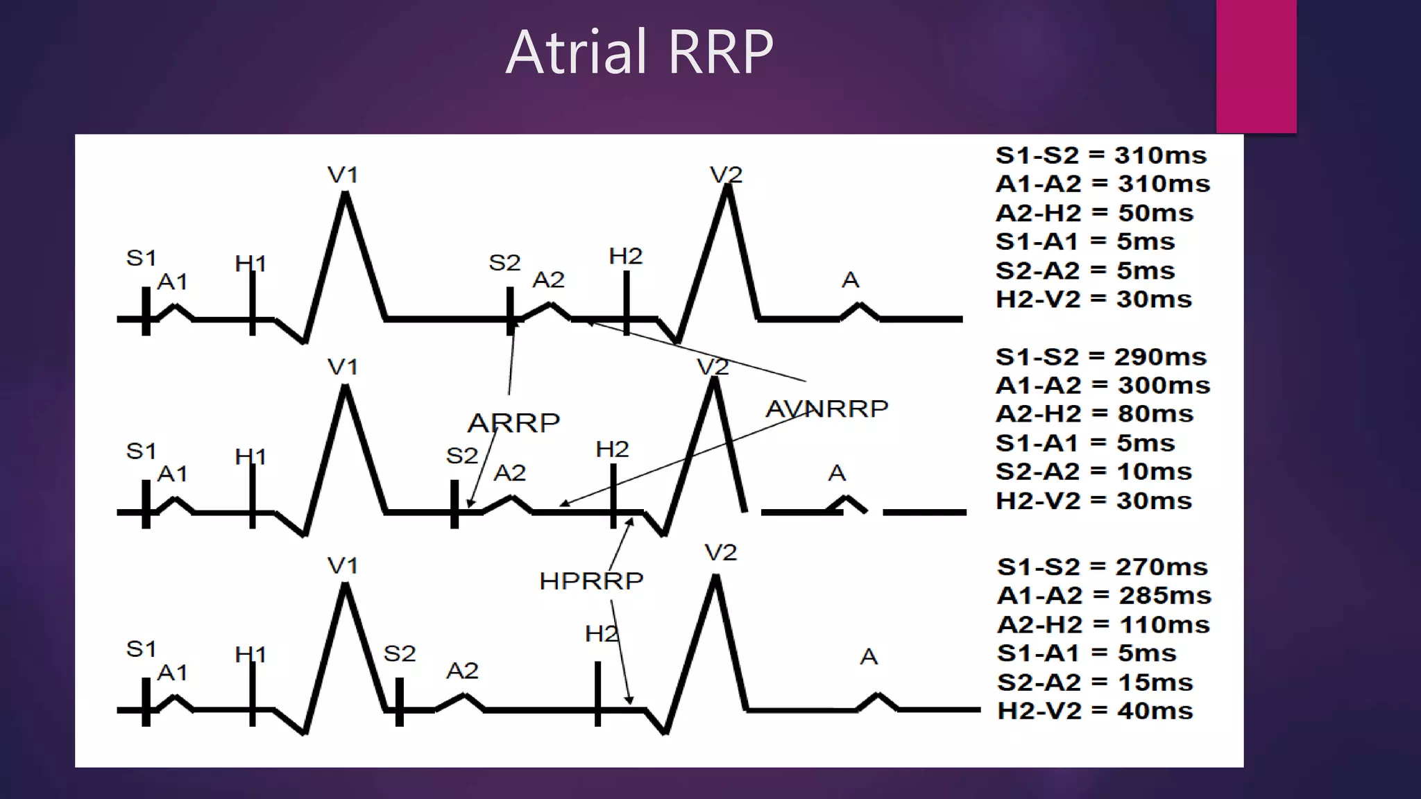 Atrial RRP
 