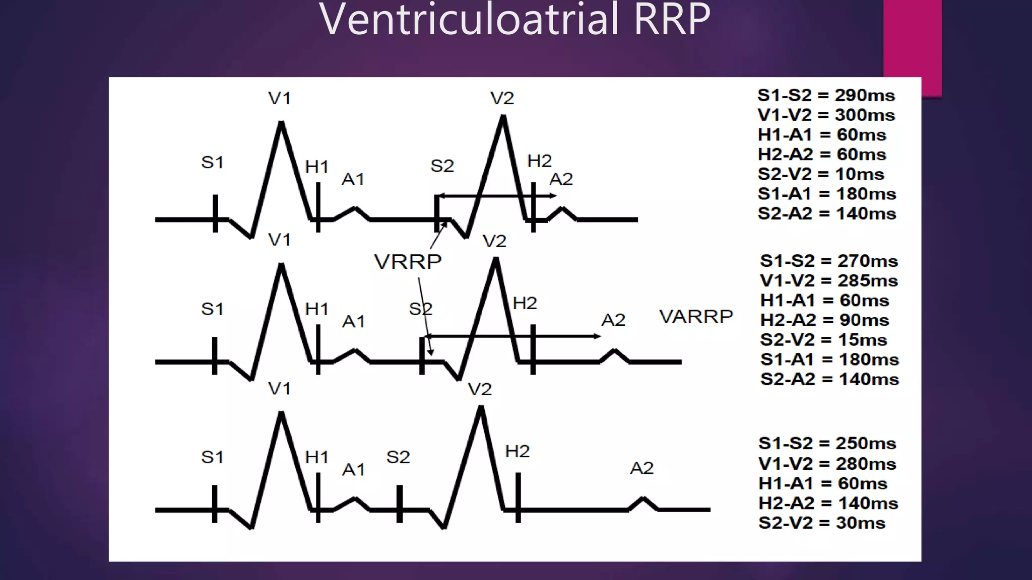 Ventriculoatrial RRP
 