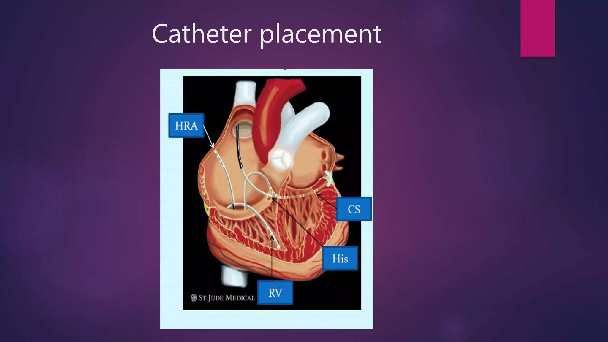 Catheter placement
 
