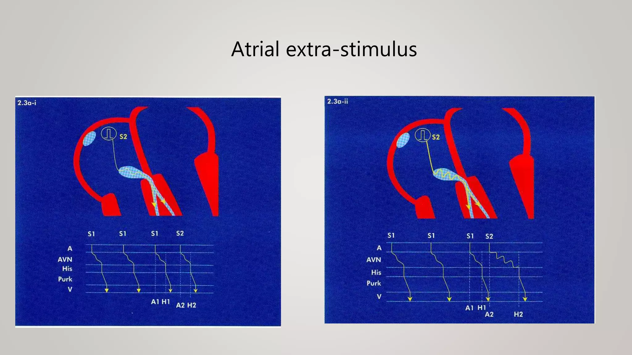 Atrial extra-stimulus
 