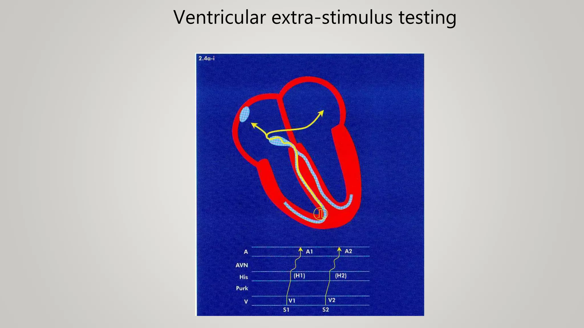 Ventricular extra-stimulus testing
 