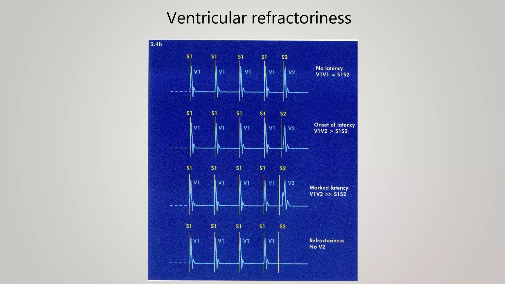 Ventricular refractoriness
 