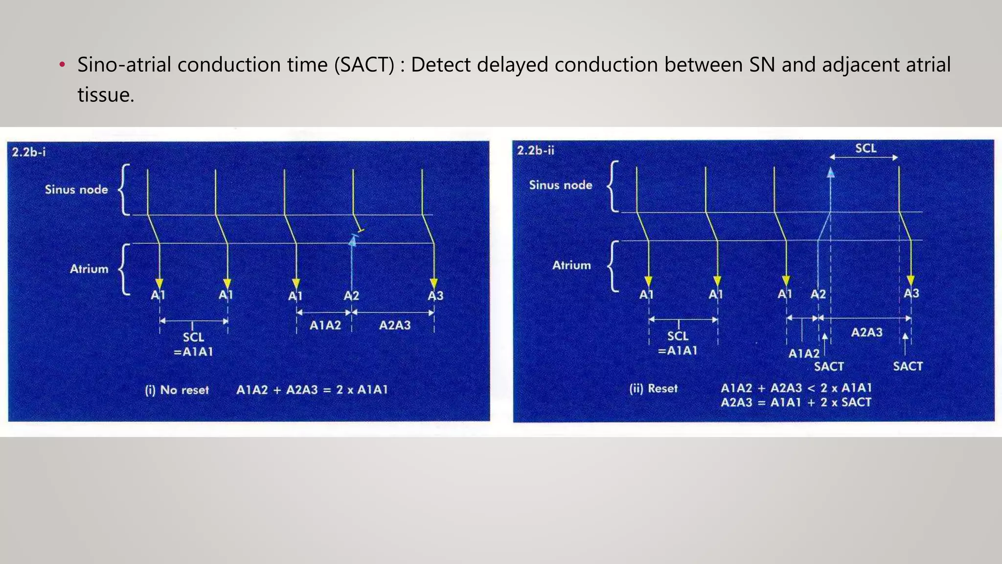 • Sino-atrial conduction time (SACT) : Detect delayed conduction between SN and adjacent atrial
tissue.
 