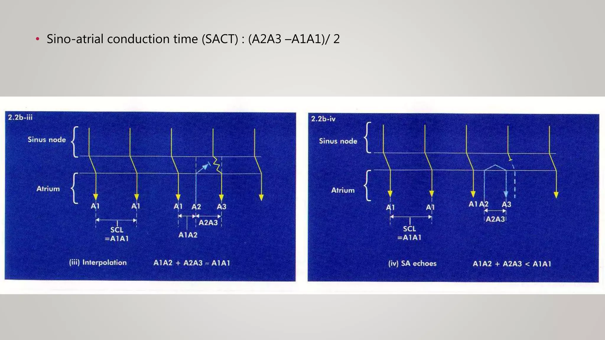 • Sino-atrial conduction time (SACT) : (A2A3 –A1A1)/ 2
 