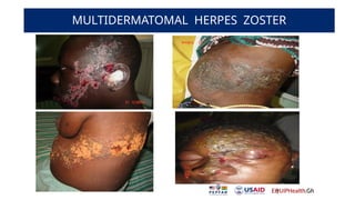 Multidermatomal BASIC FACT ON HIV/AIDS AND IT'S MANAGEMENTS | PPTX