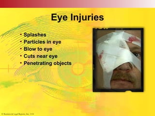 © Business & Legal Reports, Inc. 1110
Eye Injuries
• Splashes
• Particles in eye
• Blow to eye
• Cuts near eye
• Penetrating objects
© Business & Legal Reports, Inc. 1110
 