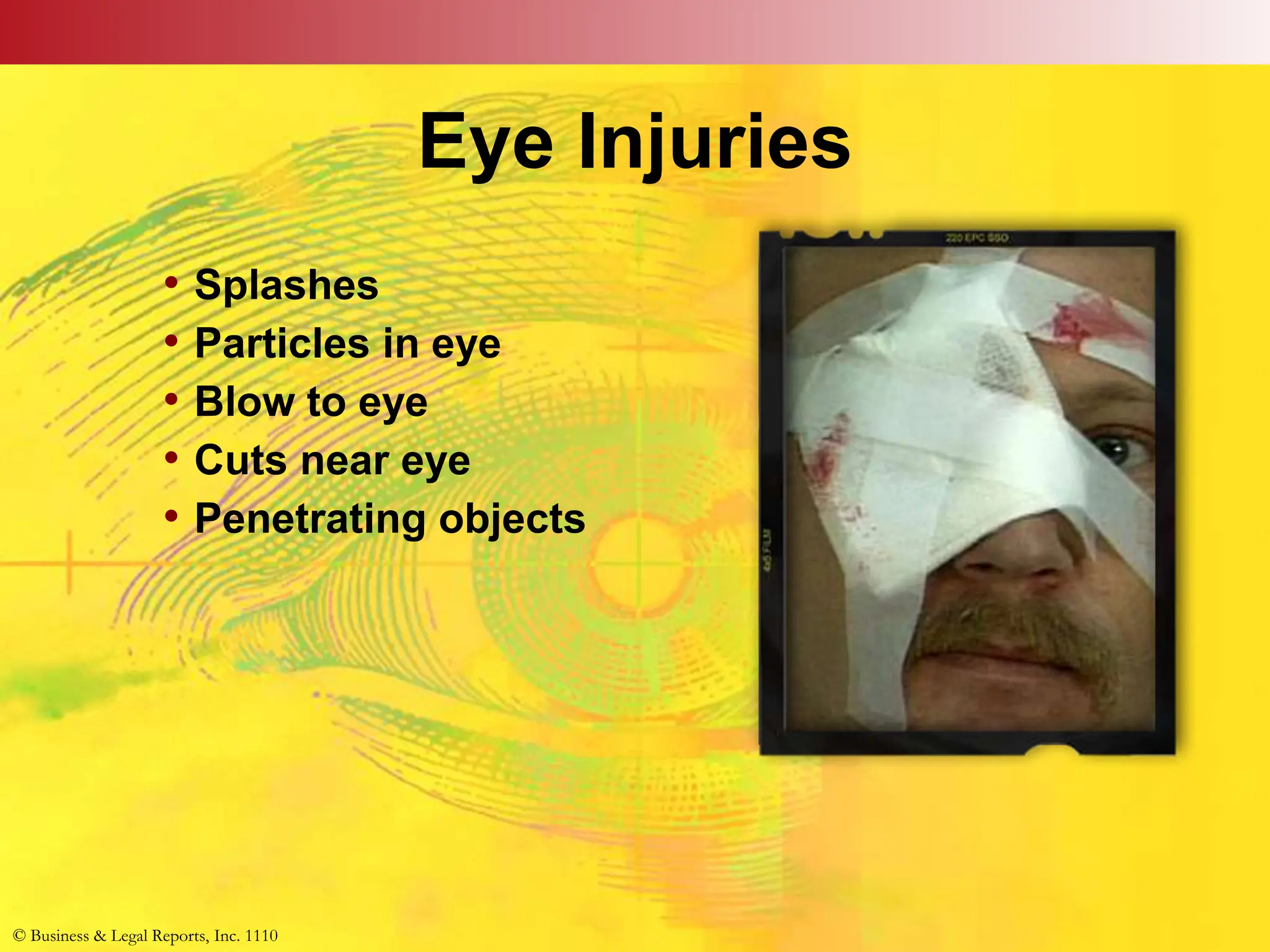 © Business & Legal Reports, Inc. 1110
Eye Injuries
• Splashes
• Particles in eye
• Blow to eye
• Cuts near eye
• Penetrating objects
© Business & Legal Reports, Inc. 1110
 