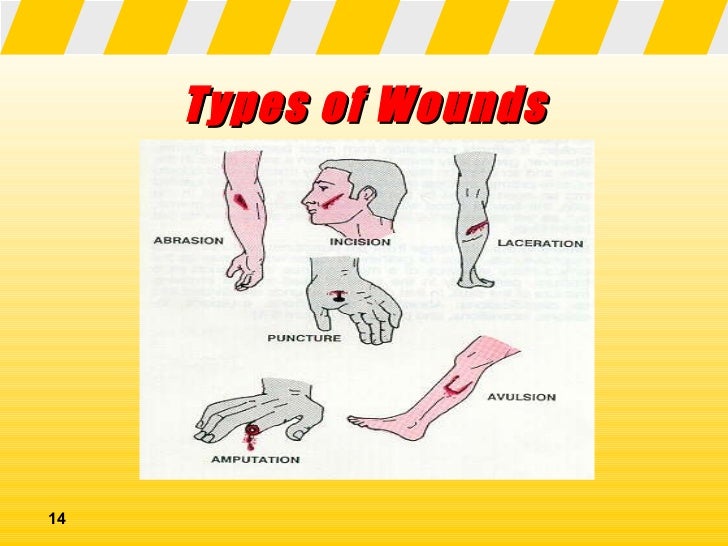 Different Types Of Wounds First Aid The Y Guide