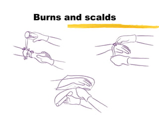 Burns and scalds 