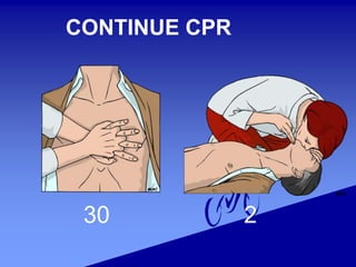 CONTINUE CPR
30 2
 