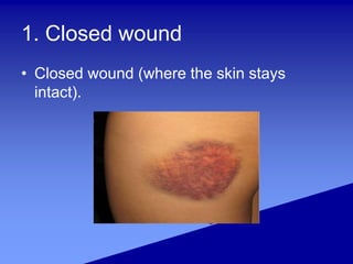 1. Closed wound
• Closed wound (where the skin stays
intact).
 