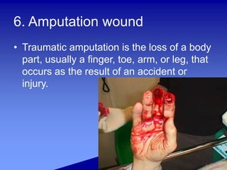 6. Amputation wound
• Traumatic amputation is the loss of a body
part, usually a finger, toe, arm, or leg, that
occurs as the result of an accident or
injury.
 